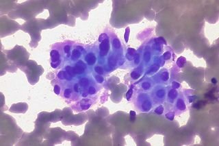 Co to są komórki nowotworowe?