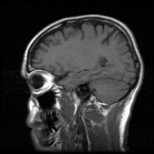 Oponiak mózgu – leczenie i rokowania