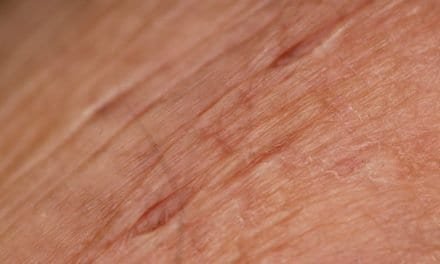 Pielęgnacja skóry w trakcie leczenia onkologicznego