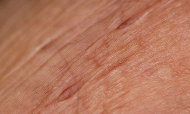 Pielęgnacja skóry w trakcie leczenia onkologicznego