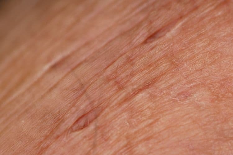 Kosmetyki dla pacjentów onkologicznych – pielęgnacja skóry