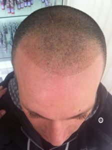 mikropigmentacja włosów przed zabiegiem mężczyzna