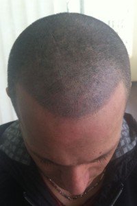 mikropigmentacja włosów po zabiegu mężczyzna