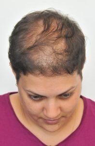 mikropigmentacja włosów przed zabiegiem kobieta