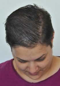 mikropigmentacja włosów po zabiegu kobieta