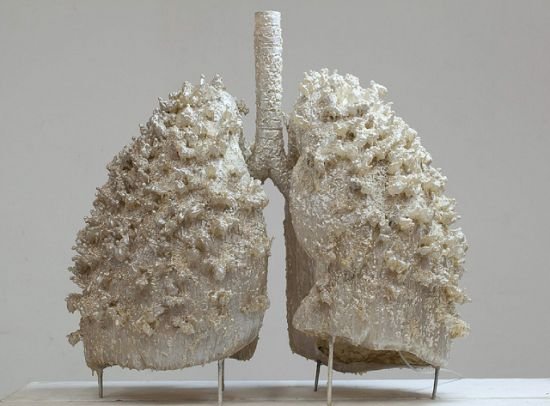 Jak zadbać o zdrowe płuca? Czynniki ryzyka i screening w raku płuca