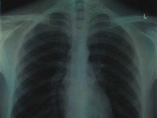 Obraz raka płuca w Polsce – leczenie farmakologiczne dziś i jutro. Prezentacja raportu