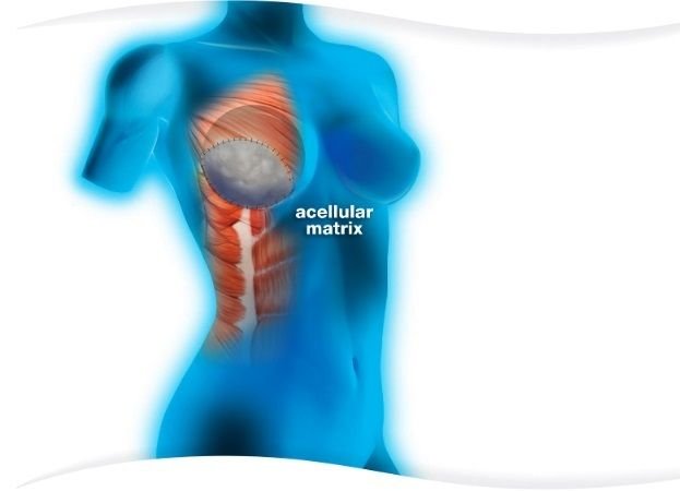 ADM (acellular dermal matrix) – macierz bezkomórkowa dla pacjentek, u których planowany jest zabieg rekonstrukcji piersi