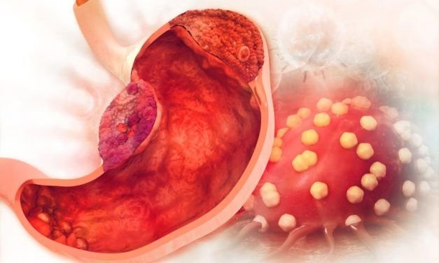 Rak żołądka – objawy i diagnostyka nowotworu