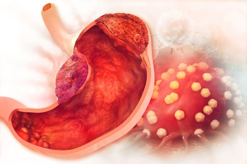 Rak żołądka – objawy i diagnostyka
