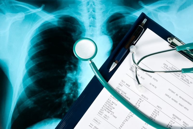 Diagnostyka raka płuc – wczesne wykrywanie