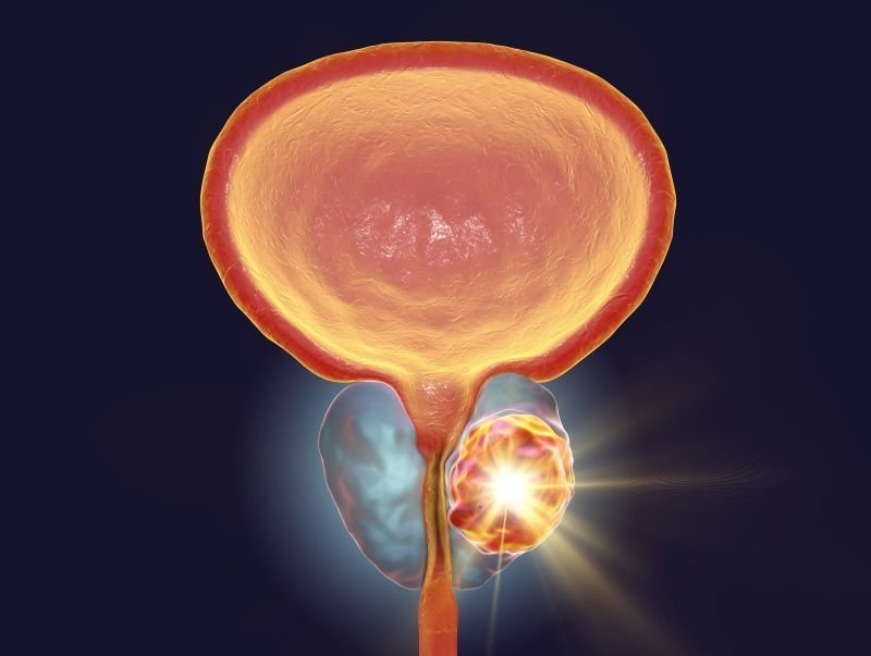 Zabieg HIFU – ultradźwięki w leczeniu raka prostaty
