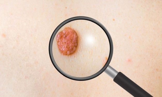 Czerniak – objawy i diagnostyka nowotworu skóry