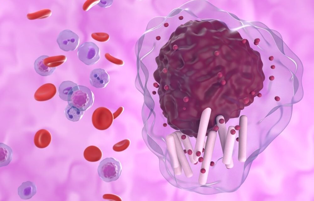 Przewlekła białaczka limfocytowa (PBL) – objawy i leczenie