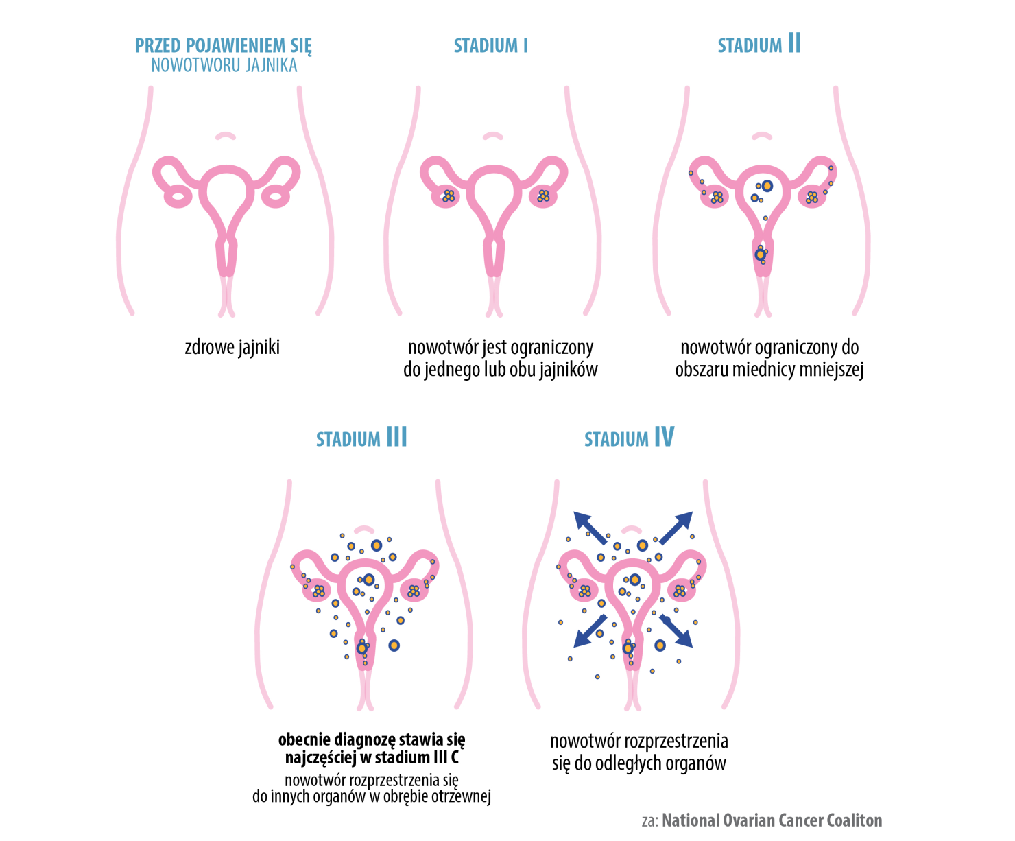 rak jajnika stadia rozwoju