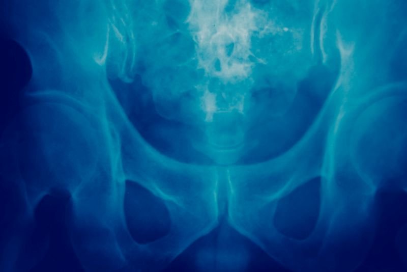 Rak kości i przerzuty do kości – objawy i leczenie
