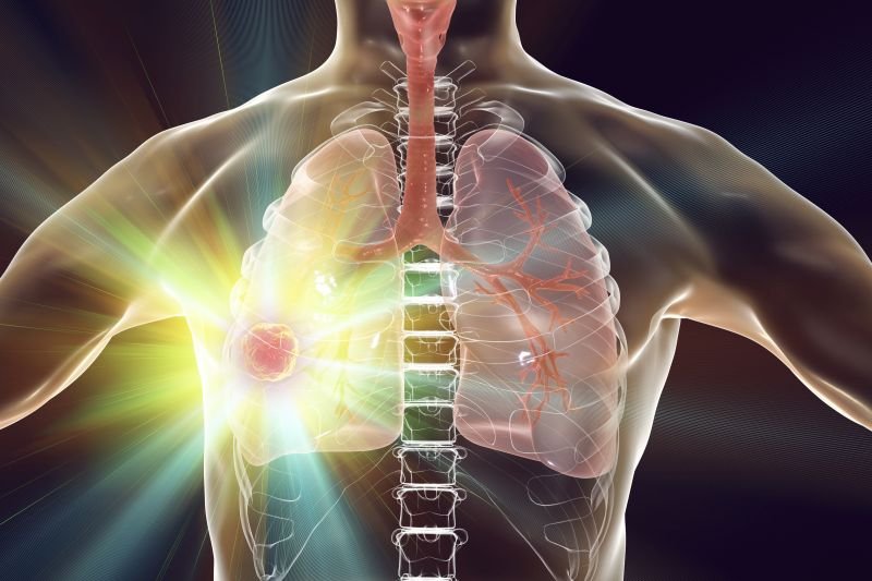 Radiochemioterapia raka niedrobnokomórkowego płuca