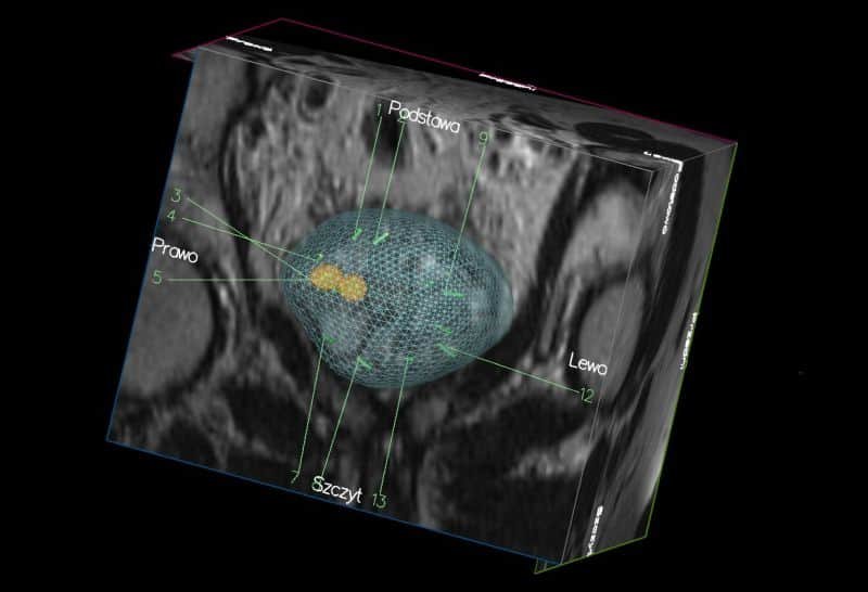 Biopsja fuzyjna gruczołu krokowego – diagnostyka raka prostaty
