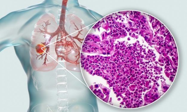 Rak płuca w trzecim stopniu zaawansowania – nowe możliwości leczenia