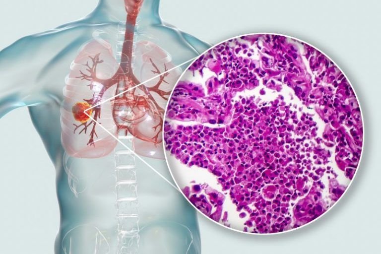 Niedrobnokomórkowy Rak Płuca Rodzaje Leczenie I Rokowania 3096