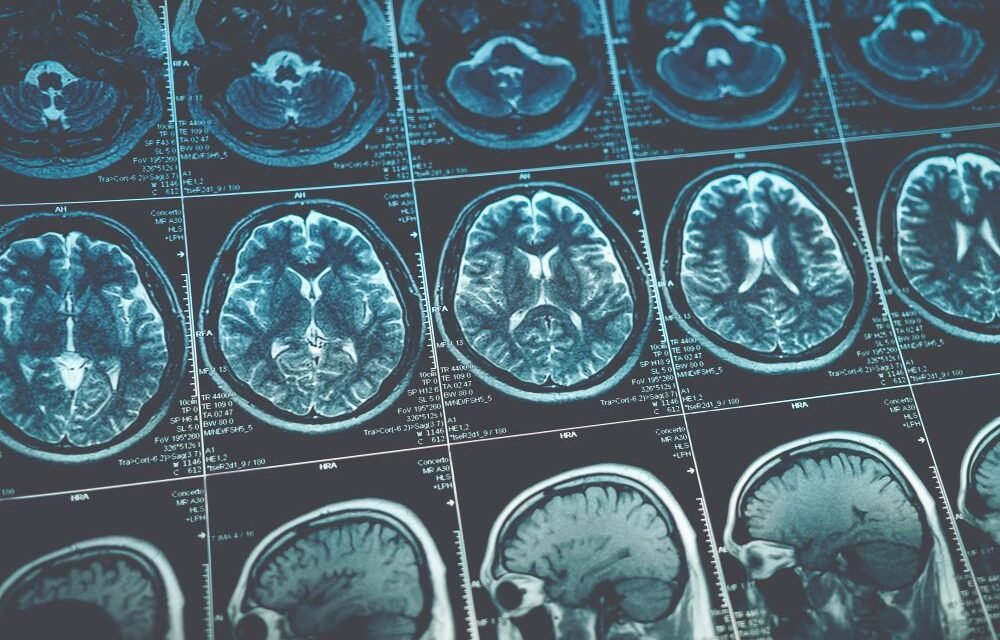 Guz mózgu – objawy i diagnostyka nowotworu