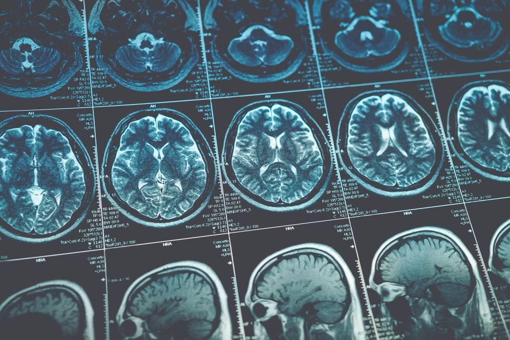 Guz mózgu – objawy i diagnostyka nowotworu