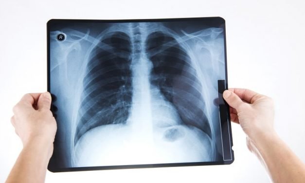 RTG klatki piersiowej – badanie rentgenowskie w diagnostyce raka