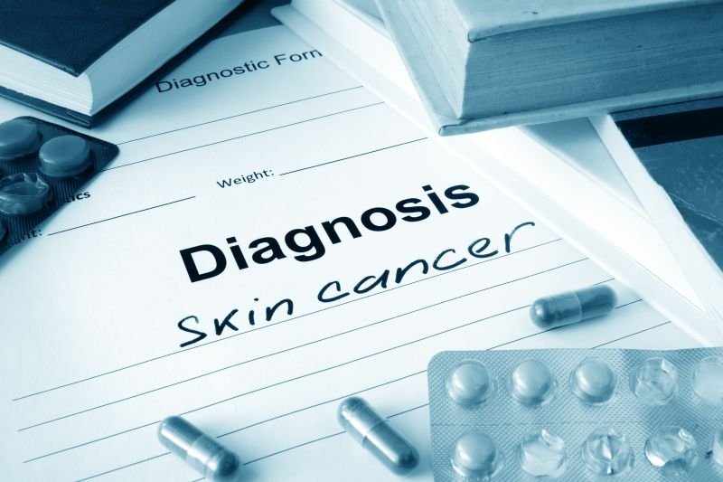 Rak kolczystokomórkowy skóry – objawy i leczenie