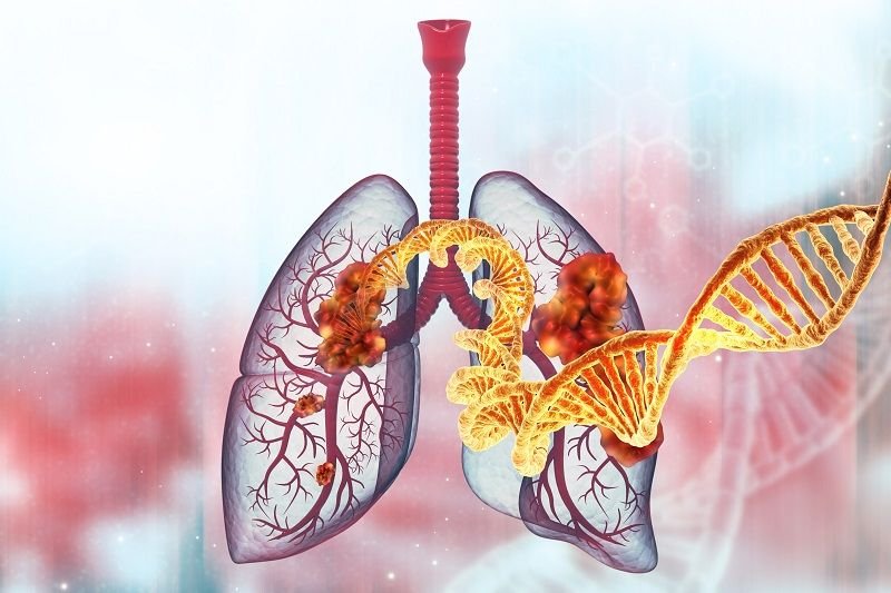 nowotwór płuca