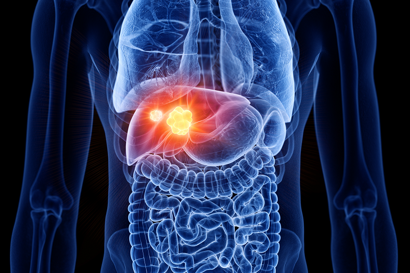 Rak wątroby – w jaki sposób wpływa na organizm? Wizualizacja 3D