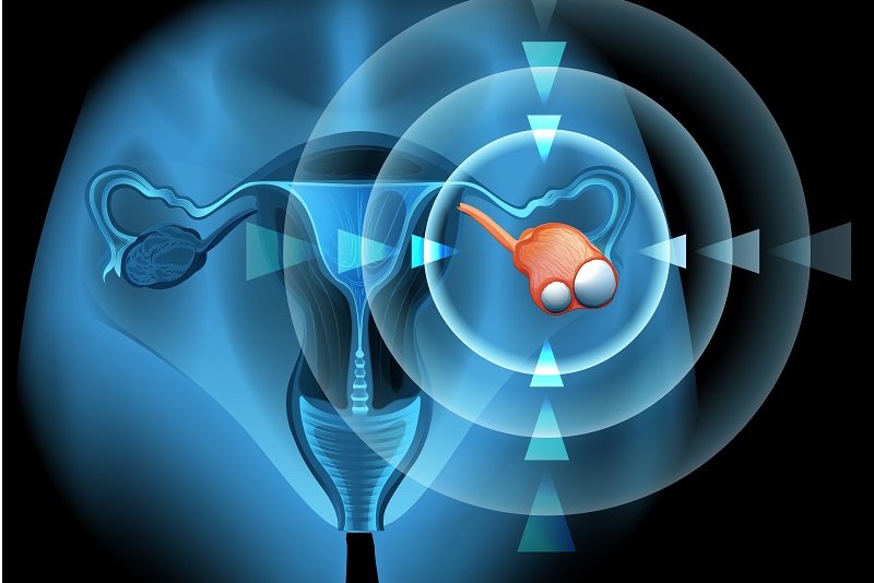 Rak jajnika – jak wygląda i jak wpływa na organizm? Wizualizacja 3D