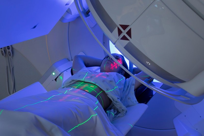 Radioterapia śródoperacyjna – na czym polega