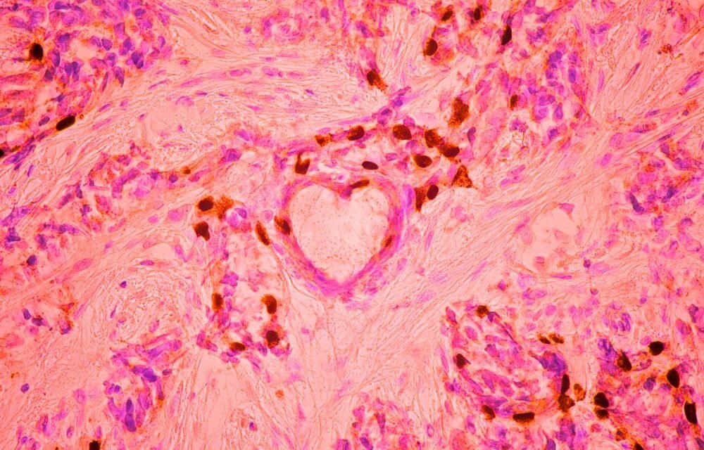 Niezwykłe zdjęcie mikroskopowe nowotworu piersi