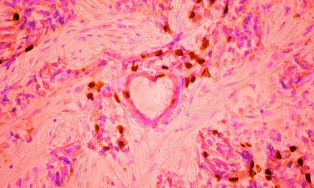 Niezwykłe zdjęcie mikroskopowe nowotworu piersi