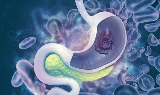 Fakty i mity o raku żołądka i Helicobacter pylori