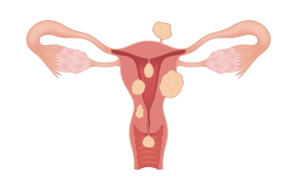 Mięśniaki macicy – objawy, diagnostyka i leczenie