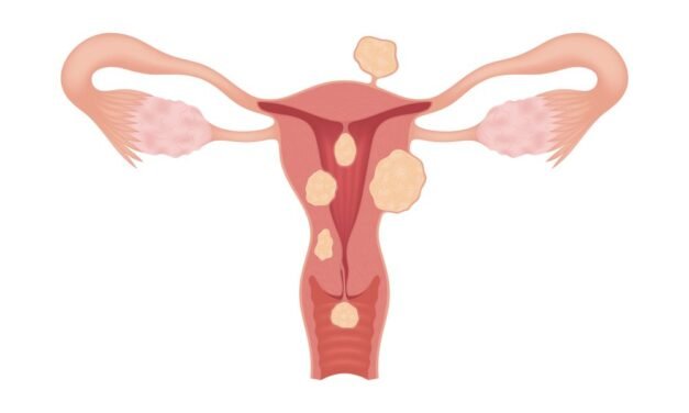 Mięśniaki macicy – objawy, diagnostyka i leczenie